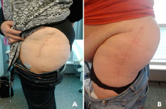 Figure 1. Skin incision directly related to body mass index in obese (A) and morbidly obese (B) patients.